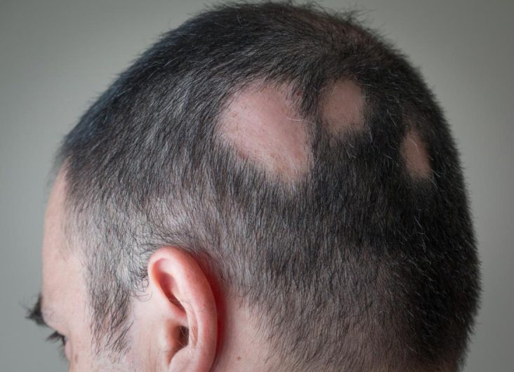 1 alopecia