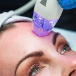 RF Microneedling: πίσω από το trend, τί πρέπει πραγματικά να ξέρουμε;