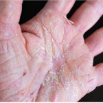 Σύγχρονες Προσεγγίσεις στην Φροντίδα του Εκζέματος Χεριών!